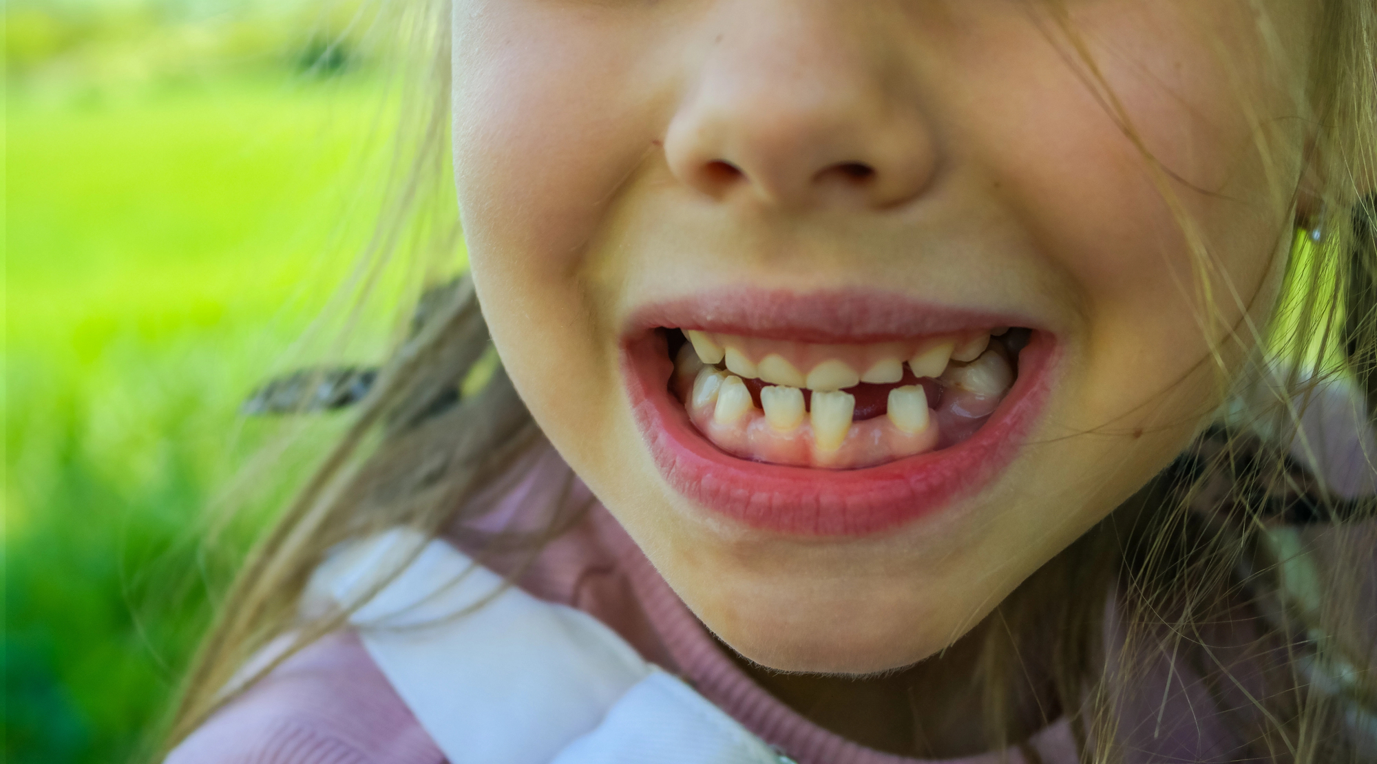 young girl's mouth with crooked teeth